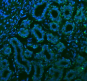 Immunofluorescent staining of FFPE human breast cancer tissue with STC2 antibody (green) and DAPI nuclear stain (blue). HIER: steam section in pH8 EDTA buffer for 20 min.