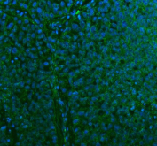 Immunofluorescent staining of FFPE human lung cancer tissue with STC2 antibody (green) and DAPI nuclear stain (blue). HIER: steam section in pH8 EDTA buffer for 20 min.