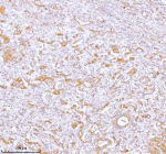 IHC analysis of STC2 using anti-STC2 antibody. STC2 was detected in a paraffin-embedded section of human rectum adenocarcinoma tissue. Heat mediated antigen retrieval was performed in EDTA buffer (pH 8.0, epitope retrieval solution). The tissue section was blocked with 10% goat serum. The tissue section was then incubated with 2 ug/ml rabbit anti-STC2 antibody overnight at 4oC. Peroxidase Conjugated Goat Anti-rabbit IgG was used as secondary antibody and incubated for 30 minutes at 37oC. The tissue section was developed using an HRP secondary and DAB substrate.