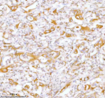 IHC analysis of STC2 using anti-STC2 antibody. STC2 was detected in a paraffin-embedded section of human rectum adenocarcinoma tissue. Heat mediated antigen retrieval was performed in EDTA buffer (pH 8.0, epitope retrieval solution). The tissue section was blocked with 10% goat serum. The tissue section was then incubated with 2 ug/ml rabbit anti-STC2 antibody overnight at 4oC. Peroxidase Conjugated Goat Anti-rabbit IgG was used as secondary antibody and incubated for 30 minutes at 37oC. The tissue section was developed using an HRP secondary and DAB substrate.