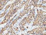 IHC analysis of RAB27B using anti-RAB27B antibody. RAB27B was detected in a paraffin-embedded section of human prostatic cancer tissue. Heat mediated antigen retrieval was performed in EDTA buffer (pH 8.0, epitope retrieval solution). The tissue section was blocked with 10% goat serum. The tissue section was then incubated with 2 ug/ml rabbit anti-RAB27B antibody overnight at 4oC. Peroxidase Conjugated Goat Anti-rabbit IgG was used as secondary antibody and incubated for 30 minutes at 37oC. The tissue section was developed using an HRP secondary and DAB substrate.
