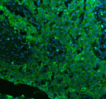 Immunofluorescent staining of RAB27B using anti-RAB27B antibody (green). RAB27B was detected in a paraffin-embedded section of human bladder cancer tissue. Heat mediated antigen retrieval was performed in EDTA buffer (pH 8.0, epitope retrieval solution). The tissue section was blocked with 10% goat serum. The tissue section was then incubated with 5 ug/ml rabbit anti-RAB27B antibody overnight at 4oC. DyLight 488 Conjugated Goat Anti-Rabbit IgG was used as secondary antibody at 1:500 dilution and incubated for 30 minutes at 37oC. The section was counterstained with DAPI (blue). Visualize using a fluorescence microscope and filter sets appropriate for the label used.