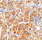 IHC analysis of SLC46A3 using anti-SLC46A3 antibody. SLC46A3 was detected in a paraffin-embedded section of human liver cancer tissue. Heat mediated antigen retrieval was performed in EDTA buffer (pH 8.0, epitope retrieval solution). The tissue section was blocked with 10% goat serum. The tissue section was then incubated with 2 ug/ml rabbit anti-SLC46A3 antibody overnight at 4oC. Peroxidase Conjugated Goat Anti-rabbit IgG was used as secondary antibody and incubated for 30 minutes at 37oC. The tissue section was developed using an HRP secondary and DAB substrate.