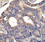 IHC analysis of NCOA2 using anti-NCOA2 antibody. NCOA2 was detected in a paraffin-embedded section of human colon cancer tissue. Heat mediated antigen retrieval was performed in EDTA buffer (pH 8.0, epitope retrieval solution). The tissue section was blocked with 10% goat serum. The tissue section was then incubated with 2 ug/ml rabbit anti-NCOA2 antibody overnight at 4oC. Peroxidase Conjugated Goat Anti-rabbit IgG was used as secondary antibody and incubated for 30 minutes at 37oC. The tissue section was developed using an HRP secondary and DAB substrate.