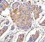 IHC analysis of PHLDB3 using anti-PHLDB3 antibody. PHLDB3 was detected in a paraffin-embedded section of human esophageal cancer tissue. Heat mediated antigen retrieval was performed in EDTA buffer (pH 8.0, epitope retrieval solution). The tissue section was blocked with 10% goat serum. The tissue section was then incubated with 2 ug/ml rabbit anti-PHLDB3 antibody overnight at 4oC. Peroxidase Conjugated Goat Anti-rabbit IgG was used as secondary antibody and incubated for 30 minutes at 37oC. The tissue section was developed using an HRP secondary and DAB substrate.