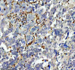 IHC analysis of GIMAP4 using anti-GIMAP4 antibody. GIMAP4 was detected in a paraffin-embedded section of human ovarian cancer tissue. Heat mediated antigen retrieval was performed in EDTA buffer (pH 8.0, epitope retrieval solution). The tissue section was blocked with 10% goat serum. The tissue section was then incubated with 2 ug/ml rabbit anti-GIMAP4 antibody overnight at 4oC. Peroxidase Conjugated Goat Anti-rabbit IgG was used as secondary antibody and incubated for 30 minutes at 37oC. The tissue section was developed using an HRP secondary and DAB substrate.