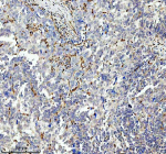 IHC analysis of GIMAP4 using anti-GIMAP4 antibody. GIMAP4 was detected in a paraffin-embedded section of human ovarian cancer tissue. Heat mediated antigen retrieval was performed in EDTA buffer (pH 8.0, epitope retrieval solution). The tissue section was blocked with 10% goat serum. The tissue section was then incubated with 2 ug/ml rabbit anti-GIMAP4 antibody overnight at 4oC. Peroxidase Conjugated Goat Anti-rabbit IgG was used as secondary antibody and incubated for 30 minutes at 37oC. The tissue section was developed using an HRP secondary and DAB substrate.