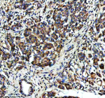 IHC analysis of SUCO using anti-SUCO antibody. SUCO was detected in a paraffin-embedded section of human pancreas cancer tissue. Heat mediated antigen retrieval was performed in EDTA buffer (pH 8.0, epitope retrieval solution). The tissue section was blocked with 10% goat serum. The tissue section was then incubated with 2 ug/ml rabbit anti-SUCO antibody overnight at 4oC. Peroxidase Conjugated Goat Anti-rabbit IgG was used as secondary antibody and incubated for 30 minutes at 37oC. The tissue section was developed using an HRP secondary and DAB substrate.