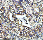 IHC analysis of SUCO using anti-SUCO antibody. SUCO was detected in a paraffin-embedded section of human pancreas cancer tissue. Heat mediated antigen retrieval was performed in EDTA buffer (pH 8.0, epitope retrieval solution). The tissue section was blocked with 10% goat serum. The tissue section was then incubated with 2 ug/ml rabbit anti-SUCO antibody overnight at 4oC. Peroxidase Conjugated Goat Anti-rabbit IgG was used as secondary antibody and incubated for 30 minutes at 37oC. The tissue section was developed using an HRP secondary and DAB substrate.