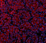 IF analysis of SUCO using anti-SUCO antibody (red). SUCO was detected in a paraffin-embedded section of human liver cancer tissue. Heat mediated antigen retrieval was performed in EDTA buffer (pH 8.0, epitope retrieval solution). The tissue section was blocked with 10% goat serum. The tissue section was then incubated with 5 ug/ml rabbit anti-SUCO antibody overnight at 4oC. Cy3 Conjugated Goat Anti-Rabbit IgG was used as secondary antibody at 1:500 dilution and incubated for 30 minutes at 37oC. The section was counterstained with DAPI (blue). Visualize using a fluorescence microscope and filter sets appropriate for the label used.
