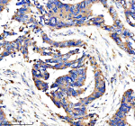 IHC analysis of AMPD1 using anti-AMPD1 antibody. AMPD1 was detected in a paraffin-embedded section of human colon cancer tissue. Heat mediated antigen retrieval was performed in EDTA buffer (pH 8.0, epitope retrieval solution). The tissue section was blocked with 10% goat serum. The tissue section was then incubated with 2 ug/ml rabbit anti-AMPD1 antibody overnight at 4oC. Peroxidase Conjugated Goat Anti-rabbit IgG was used as secondary antibody and incubated for 30 minutes at 37oC. The tissue section was developed using an HRP secondary and DAB substrate.