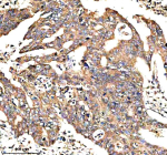IHC analysis of NEK9 using anti-NEK9 antibody. NEK9 was detected in a paraffin-embedded section of human colon cancer tissue. Heat mediated antigen retrieval was performed in EDTA buffer (pH 8.0, epitope retrieval solution). The tissue section was blocked with 10% goat serum. The tissue section was then incubated with 2 ug/ml rabbit anti-NEK9 antibody overnight at 4oC. Peroxidase Conjugated Goat Anti-rabbit IgG was used as secondary antibody and incubated for 30 minutes at 37oC. The tissue section was developed using an HRP secondary and DAB substrate.