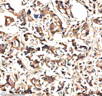 IHC analysis of NEK9 using anti-NEK9 antibody. NEK9 was detected in a paraffin-embedded section of human breast cancer tissue. Heat mediated antigen retrieval was performed in EDTA buffer (pH 8.0, epitope retrieval solution). The tissue section was blocked with 10% goat serum. The tissue section was then incubated with 2 ug/ml rabbit anti-NEK9 antibody overnight at 4oC. Peroxidase Conjugated Goat Anti-rabbit IgG was used as secondary antibody and incubated for 30 minutes at 37oC. The tissue section was developed using an HRP secondary and DAB substrate.