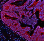 IF analysis of NEK9 using anti-NEK9 antibody (red). NEK9 was detected in a paraffin-embedded section of human colon cancer tissue. Heat mediated antigen retrieval was performed in EDTA buffer (pH 8.0, epitope retrieval solution). The tissue section was blocked with 10% goat serum. The tissue section was then incubated with 5 ug/ml rabbit anti-NEK9 antibody overnight at 4oC. Cy3 Conjugated Goat Anti-Rabbit IgG was used as secondary antibody at 1:500 dilution and incubated for 30 minutes at 37oC. The section was counterstained with DAPI (blue). Visualize using a fluorescence microscope and filter sets appropriate for the label used.