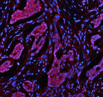 IF analysis of NEK9 using anti-NEK9 antibody (red). NEK9 was detected in a paraffin-embedded section of human breast cancer tissue. Heat mediated antigen retrieval was performed in EDTA buffer (pH 8.0, epitope retrieval solution). The tissue section was blocked with 10% goat serum. The tissue section was then incubated with 5 ug/ml rabbit anti-NEK9 antibody overnight at 4oC. Cy3 Conjugated Goat Anti-Rabbit IgG was used as secondary antibody at 1:500 dilution and incubated for 30 minutes at 37oC. The section was counterstained with DAPI (blue). Visualize using a fluorescence microscope and filter sets appropriate for the label used.