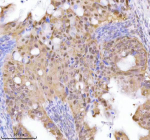 IHC analysis of RBBP8 using anti-RBBP8 antibody. RBBP8 was detected in a paraffin-embedded section of human mucinous adenoma of ovary tissue. Heat mediated antigen retrieval was performed in EDTA buffer (pH 8.0, epitope retrieval solution). The tissue section was blocked with 10% goat serum. The tissue section was then incubated with 2 ug/ml rabbit anti-RBBP8 antibody overnight at 4oC. Peroxidase Conjugated Goat Anti-rabbit IgG was used as secondary antibody and incubated for 30 minutes at 37oC. The tissue section was developed using an HRP secondary and DAB substrate.
