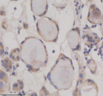 IHC analysis of SIL1 using anti-SIL1 antibody. SIL1 was detected in a paraffin-embedded section of human thyroid cancer tissue. Heat mediated antigen retrieval was performed in EDTA buffer (pH 8.0, epitope retrieval solution). The tissue section was blocked with 10% goat serum. The tissue section was then incubated with 2 ug/ml rabbit anti-SIL1 antibody overnight at 4oC. Peroxidase Conjugated Goat Anti-rabbit IgG was used as secondary antibody and incubated for 30 minutes at 37oC. The tissue section was developed using an HRP secondary and DAB substrate.