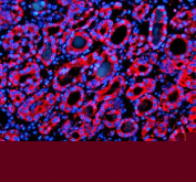 Immunofluorescent staining of SIL1 using anti-SIL1 antibody (red). SIL1 was detected in a paraffin-embedded section of human thyroid cancer tissue. Heat mediated antigen retrieval was performed in EDTA buffer (pH 8.0, epitope retrieval solution). The tissue section was blocked with 10% goat serum. The tissue section was then incubated with 5 ug/ml rabbit anti-SIL1 antibody overnight at 4oC. Cy3 Conjugated Goat Anti-Rabbit IgG was used as secondary antibody at 1:500 dilution and incubated for 30 minutes at 37oC. The section was counterstained with DAPI (blue). Visualize using a fluorescence microscope and filter sets appropriate for the label used.