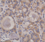 IHC analysis of SIL1 using anti-SIL1 antibody. SIL1 was detected in a paraffin-embedded section of human thyroid cancer tissue. Heat mediated antigen retrieval was performed in EDTA buffer (pH 8.0, epitope retrieval solution). The tissue section was blocked with 10% goat serum. The tissue section was then incubated with 2 ug/ml rabbit anti-SIL1 antibody overnight at 4oC. Peroxidase Conjugated Goat Anti-rabbit IgG was used as secondary antibody and incubated for 30 minutes at 37oC. The tissue section was developed using an HRP secondary and DAB substrate.