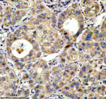 IHC analysis of TOP1MT using anti-TOP1MT antibody. TOP1MT was detected in a paraffin-embedded section of human liver cancer tissue. Heat mediated antigen retrieval was performed in EDTA buffer (pH 8.0, epitope retrieval solution). The tissue section was blocked with 10% goat serum. The tissue section was then incubated with 2 ug/ml rabbit anti-TOP1MT antibody overnight at 4oC. Peroxidase Conjugated Goat Anti-rabbit IgG was used as secondary antibody and incubated for 30 minutes at 37oC. The tissue section was developed using an HRP secondary and DAB substrate.