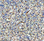 IHC analysis of KCNA6 using anti-KCNA6 antibody. KCNA6 was detected in a paraffin-embedded section of human glioma tissue. Heat mediated antigen retrieval was performed in EDTA buffer (pH 8.0, epitope retrieval solution). The tissue section was blocked with 10% goat serum. The tissue section was then incubated with 2 ug/ml rabbit anti-KCNA6 antibody overnight at 4oC. Peroxidase Conjugated Goat Anti-rabbit IgG was used as secondary antibody and incubated for 30 minutes at 37oC. The tissue section was developed using an HRP secondary and DAB substrate.