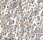 IHC analysis of KCNA6 using anti-KCNA6 antibody. KCNA6 was detected in a paraffin-embedded section of human testis cancer tissue. Heat mediated antigen retrieval was performed in EDTA buffer (pH 8.0, epitope retrieval solution). The tissue section was blocked with 10% goat serum. The tissue section was then incubated with 2 ug/ml rabbit anti-KCNA6 antibody overnight at 4oC. Peroxidase Conjugated Goat Anti-rabbit IgG was used as secondary antibody and incubated for 30 minutes at 37oC. The tissue section was developed using an HRP secondary and DAB substrate.