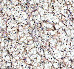 IHC analysis of KCNA6 using anti-KCNA6 antibody. KCNA6 was detected in a paraffin-embedded section of human renal cancer tissue. Heat mediated antigen retrieval was performed in EDTA buffer (pH 8.0, epitope retrieval solution). The tissue section was blocked with 10% goat serum. The tissue section was then incubated with 2 ug/ml rabbit anti-KCNA6 antibody overnight at 4oC. Peroxidase Conjugated Goat Anti-rabbit IgG was used as secondary antibody and incubated for 30 minutes at 37oC. The tissue section was developed using an HRP secondary and DAB substrate.