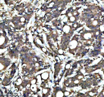 IHC analysis of KCNA6 using anti-KCNA6 antibody. KCNA6 was detected in a paraffin-embedded section of human colon cancer tissue. Heat mediated antigen retrieval was performed in EDTA buffer (pH 8.0, epitope retrieval solution). The tissue section was blocked with 10% goat serum. The tissue section was then incubated with 2 ug/ml rabbit anti-KCNA6 antibody overnight at 4oC. Peroxidase Conjugated Goat Anti-rabbit IgG was used as secondary antibody and incubated for 30 minutes at 37oC. The tissue section was developed using an HRP secondary and DAB substrate.