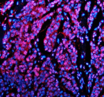 Immunofluorescent staining of PABPN1 using anti-PABPN1 antibody (red). PABPN1 was detected in a paraffin-embedded section of human colon cancer tissue. Heat mediated antigen retrieval was performed in EDTA buffer (pH 8.0, epitope retrieval solution). The tissue section was blocked with 10% goat serum. The tissue section was then incubated with 5 ug/ml rabbit anti-PABPN1 antibody overnight at 4oC. Cy3 Conjugated Goat Anti-Rabbit IgG was used as secondary antibody at 1:500 dilution and incubated for 30 minutes at 37oC. The section was counterstained with DAPI (blue). Visualize using a fluorescence microscope and filter sets appropriate for the label used.