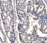 IHC analysis of PABPN1 using anti-PABPN1 antibody. PABPN1 was detected in a paraffin-embedded section of human colon cancer tissue. Heat mediated antigen retrieval was performed in EDTA buffer (pH 8.0, epitope retrieval solution). The tissue section was blocked with 10% goat serum. The tissue section was then incubated with 2 ug/ml rabbit anti-PABPN1 antibody overnight at 4oC. Peroxidase Conjugated Goat Anti-rabbit IgG was used as secondary antibody and incubated for 30 minutes at 37oC. The tissue section was developed using an HRP secondary and DAB substrate.