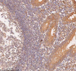 IHC analysis of SAMD9L using anti-SAMD9L antibody. SAMD9L was detected in a paraffin-embedded section of human appendiceal carcinoid tissue. Heat mediated antigen retrieval was performed in EDTA buffer (pH 8.0, epitope retrieval solution). The tissue section was blocked with 10% goat serum. The tissue section was then incubated with 2 ug/ml rabbit anti-SAMD9L antibody overnight at 4oC. Peroxidase Conjugated Goat Anti-rabbit IgG was used as secondary antibody and incubated for 30 minutes at 37oC. The tissue section was developed using an HRP secondary and DAB substrate.