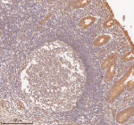 IHC analysis of SAMD9L using anti-SAMD9L antibody. SAMD9L was detected in a paraffin-embedded section of human appendiceal carcinoid tissue. Heat mediated antigen retrieval was performed in EDTA buffer (pH 8.0, epitope retrieval solution). The tissue section was blocked with 10% goat serum. The tissue section was then incubated with 2 ug/ml rabbit anti-SAMD9L antibody overnight at 4oC. Peroxidase Conjugated Goat Anti-rabbit IgG was used as secondary antibody and incubated for 30 minutes at 37oC. The tissue section was developed using an HRP secondary and DAB substrate.