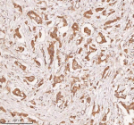 IHC analysis of SAMD9L using anti-SAMD9L antibody. SAMD9L was detected in a paraffin-embedded section of human breast cancer tissue. Heat mediated antigen retrieval was performed in EDTA buffer (pH 8.0, epitope retrieval solution). The tissue section was blocked with 10% goat serum. The tissue section was then incubated with 2 ug/ml rabbit anti-SAMD9L antibody overnight at 4oC. Peroxidase Conjugated Goat Anti-rabbit IgG was used as secondary antibody and incubated for 30 minutes at 37oC. The tissue section was developed using an HRP secondary and DAB substrate.