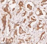 IHC analysis of SAMD9L using anti-SAMD9L antibody. SAMD9L was detected in a paraffin-embedded section of human breast cancer tissue. Heat mediated antigen retrieval was performed in EDTA buffer (pH 8.0, epitope retrieval solution). The tissue section was blocked with 10% goat serum. The tissue section was then incubated with 2 ug/ml rabbit anti-SAMD9L antibody overnight at 4oC. Peroxidase Conjugated Goat Anti-rabbit IgG was used as secondary antibody and incubated for 30 minutes at 37oC. The tissue section was developed using an HRP secondary and DAB substrate.