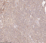 IHC analysis of SAMD9L using anti-SAMD9L antibody. SAMD9L was detected in a paraffin-embedded section of human cervix squamous cell carcinoma tissue. Heat mediated antigen retrieval was performed in EDTA buffer (pH 8.0, epitope retrieval solution). The tissue section was blocked with 10% goat serum. The tissue section was then incubated with 2 ug/ml rabbit anti-SAMD9L antibody overnight at 4oC. Peroxidase Conjugated Goat Anti-rabbit IgG was used as secondary antibody and incubated for 30 minutes at 37oC. The tissue section was developed using an HRP secondary and DAB substrate.