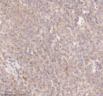 IHC analysis of SAMD9L using anti-SAMD9L antibody. SAMD9L was detected in a paraffin-embedded section of human cervix squamous cell carcinoma tissue. Heat mediated antigen retrieval was performed in EDTA buffer (pH 8.0, epitope retrieval solution). The tissue section was blocked with 10% goat serum. The tissue section was then incubated with 2 ug/ml rabbit anti-SAMD9L antibody overnight at 4oC. Peroxidase Conjugated Goat Anti-rabbit IgG was used as secondary antibody and incubated for 30 minutes at 37oC. The tissue section was developed using an HRP secondary and DAB substrate.