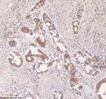 IHC analysis of SAMD9L using anti-SAMD9L antibody. SAMD9L was detected in a paraffin-embedded section of human rectum adenocarcinoma tissue. Heat mediated antigen retrieval was performed in EDTA buffer (pH 8.0, epitope retrieval solution). The tissue section was blocked with 10% goat serum. The tissue section was then incubated with 2 ug/ml rabbit anti-SAMD9L antibody overnight at 4oC. Peroxidase Conjugated Goat Anti-rabbit IgG was used as secondary antibody and incubated for 30 minutes at 37oC. The tissue section was developed using an HRP secondary and DAB substrate.
