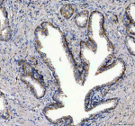 IHC analysis of PLD5 using anti-PLD5 antibody. PLD5 was detected in a paraffin-embedded section of human prostate cancer tissue. Heat mediated antigen retrieval was performed in EDTA buffer (pH 8.0, epitope retrieval solution). The tissue section was blocked with 10% goat serum. The tissue section was then incubated with 2 ug/ml rabbit anti-PLD5 antibody overnight at 4oC. Peroxidase Conjugated Goat Anti-rabbit IgG was used as secondary antibody and incubated for 30 minutes at 37oC. The tissue section was developed using an HRP secondary and DAB substrate.