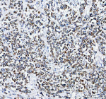 IHC analysis of PLD5 using anti-PLD5 antibody. PLD5 was detected in a paraffin-embedded section of human breast cancer tissue. Heat mediated antigen retrieval was performed in EDTA buffer (pH 8.0, epitope retrieval solution). The tissue section was blocked with 10% goat serum. The tissue section was then incubated with 2 ug/ml rabbit anti-PLD5 antibody overnight at 4oC. Peroxidase Conjugated Goat Anti-rabbit IgG was used as secondary antibody and incubated for 30 minutes at 37oC. The tissue section was developed using an HRP secondary and DAB substrate.