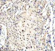 IHC analysis of TTC34 using anti-TTC34 antibody. TTC34 was detected in a paraffin-embedded section of human cervical cancer tissue. Heat mediated antigen retrieval was performed in EDTA buffer (pH 8.0, epitope retrieval solution). The tissue section was blocked with 10% goat serum. The tissue section was then incubated with 2 ug/ml rabbit anti-TTC34 antibody overnight at 4oC. Peroxidase Conjugated Goat Anti-rabbit IgG was used as secondary antibody and incubated for 30 minutes at 37oC. The tissue section was developed using an HRP secondary and DAB substrate.