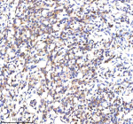 IHC analysis of SCNM1 using anti-SCNM1 antibody. SCNM1 was detected in a paraffin-embedded section of human stomach cancer tissue. Heat mediated antigen retrieval was performed in EDTA buffer (pH 8.0, epitope retrieval solution). The tissue section was blocked with 10% goat serum. The tissue section was then incubated with 2 ug/ml rabbit anti-SCNM1 antibody overnight at 4oC. Peroxidase Conjugated Goat Anti-rabbit IgG was used as secondary antibody and incubated for 30 minutes at 37oC. The tissue section was developed using an HRP secondary and DAB substrate.