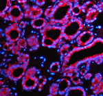 IF analysis of SEC63 using anti-SEC63 antibody (red). SEC63 was detected in a paraffin-embedded section of human thyroid cancer tissue. Heat mediated antigen retrieval was performed in EDTA buffer (pH 8.0, epitope retrieval solution). The tissue section was blocked with 10% goat serum. The tissue section was then incubated with 5 ug/ml rabbit anti-SEC63 antibody overnight at 4oC. Cy3 Conjugated Goat Anti-Rabbit IgG was used as secondary antibody at 1:500 dilution and incubated for 30 minutes at 37oC. The section was counterstained with DAPI (blue). Visualize using a fluorescence microscope and filter sets appropriate for the label used.