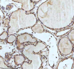 IHC analysis of IRF2BPL using anti-IRF2BPL antibody. IRF2BPL was detected in a paraffin-embedded section of follicles of human thyroid cancer tissue. Heat mediated antigen retrieval was performed in EDTA buffer (pH 8.0, epitope retrieval solution). The tissue section was blocked with 10% goat serum. The tissue section was then incubated with 2 ug/ml rabbit anti-IRF2BPL antibody overnight at 4oC. Peroxidase Conjugated Goat Anti-rabbit IgG was used as secondary antibody and incubated for 30 minutes at 37oC. The tissue section was developed using an HRP secondary and DAB substrate.