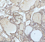 IHC analysis of IRF2BPL using anti-IRF2BPL antibody. IRF2BPL was detected in a paraffin-embedded section of follicles of human thyroid cancer tissue. Heat mediated antigen retrieval was performed in EDTA buffer (pH 8.0, epitope retrieval solution). The tissue section was blocked with 10% goat serum. The tissue section was then incubated with 2 ug/ml rabbit anti-IRF2BPL antibody overnight at 4oC. Peroxidase Conjugated Goat Anti-rabbit IgG was used as secondary antibody and incubated for 30 minutes at 37oC. The tissue section was developed using an HRP secondary and DAB substrate.