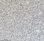 IHC analysis of IRF2BPL using anti-IRF2BPL antibody. IRF2BPL was detected in a paraffin-embedded section of follicles of human glioma tissue. Heat mediated antigen retrieval was performed in EDTA buffer (pH 8.0, epitope retrieval solution). The tissue section was blocked with 10% goat serum. The tissue section was then incubated with 2 ug/ml rabbit anti-IRF2BPL antibody overnight at 4oC. Peroxidase Conjugated Goat Anti-rabbit IgG was used as secondary antibody and incubated for 30 minutes at 37oC. The tissue section was developed using an HRP secondary and DAB substrate.