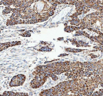 IHC analysis of CAMKK2 using anti-CAMKK2 antibody. CAMKK2 was detected in a paraffin-embedded section of human esophageal squamous carcinoma tissue. Heat mediated antigen retrieval was performed in EDTA buffer (pH 8.0, epitope retrieval solution). The tissue section was blocked with 10% goat serum. The tissue section was then incubated with 2 ug/ml rabbit anti-CAMKK2 antibody overnight at 4oC. Peroxidase Conjugated Goat Anti-rabbit IgG was used as secondary antibody and incubated for 30 minutes at 37oC. The tissue section was developed using an HRP secondary and DAB substrate.