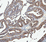 IHC analysis of CAMKK2 using anti-CAMKK2 antibody. CAMKK2 was detected in a paraffin-embedded section of human colorectal adenocarcinoma tissue. Heat mediated antigen retrieval was performed in EDTA buffer (pH 8.0, epitope retrieval solution). The tissue section was blocked with 10% goat serum. The tissue section was then incubated with 2 ug/ml rabbit anti-CAMKK2 antibody overnight at 4oC. Peroxidase Conjugated Goat Anti-rabbit IgG was used as secondary antibody and incubated for 30 minutes at 37oC. The tissue section was developed using an HRP secondary and DAB substrate.
