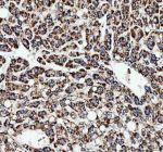 IHC analysis of CAMKK2 using anti-CAMKK2 antibody. CAMKK2 was detected in a paraffin-embedded section of human liver cancer tissue. Heat mediated antigen retrieval was performed in EDTA buffer (pH 8.0, epitope retrieval solution). The tissue section was blocked with 10% goat serum. The tissue section was then incubated with 2 ug/ml rabbit anti-CAMKK2 antibody overnight at 4oC. Peroxidase Conjugated Goat Anti-rabbit IgG was used as secondary antibody and incubated for 30 minutes at 37oC. The tissue section was developed using an HRP secondary and DAB substrate.