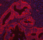 Immunofluorescent staining of CAMKK2 using anti-CAMKK2 antibody (red). CAMKK2 was detected in a paraffin-embedded section of human intestinal cancer tissue. Heat mediated antigen retrieval was performed in EDTA buffer (pH 8.0, epitope retrieval solution). The tissue section was blocked with 10% goat serum. The tissue section was then incubated with 5 ug/ml rabbit anti-CAMKK2 antibody overnight at 4oC. Cy3-conjugated Anti-rabbit IgG Secondary antibody was used as secondary antibody at 1:500 dilution and incubated for 30 minutes at 37oC. The section was counterstained with DAPI (blue). Visualize using a fluorescence microscope and filter sets appropriate for the label used.