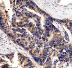 IHC analysis of UBE2A/UBE2B using anti-UBE2A/UBE2B antibody. UBE2A/UBE2B was detected in a paraffin-embedded section of human colon cancer tissue. Heat mediated antigen retrieval was performed in EDTA buffer (pH 8.0, epitope retrieval solution). The tissue section was blocked with 10% goat serum. The tissue section was then incubated with 2 ug/ml rabbit anti-UBE2A/UBE2B antibody overnight at 4oC. Peroxidase Conjugated Goat Anti-rabbit IgG was used as secondary antibody and incubated for 30 minutes at 37oC. The tissue section was developed using an HRP secondary and DAB substrate.